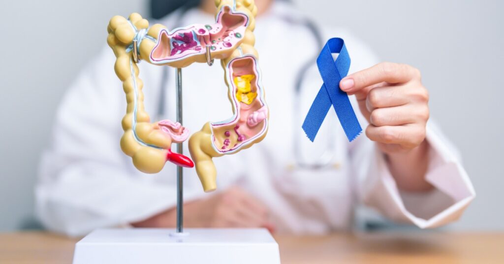 Doctor holding Blue ribbon with human Colon anatomy model. March Colorectal Cancer Awareness month, Colonic disease, Large Intestine, Ulcerative colitis, Digestive system and Health