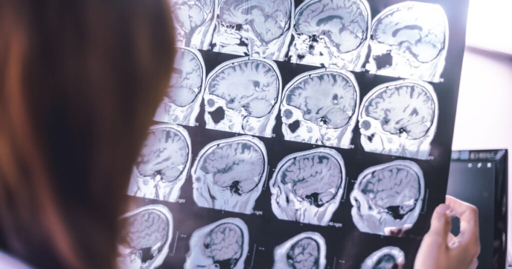 frontal lobe atrophy on MRI film