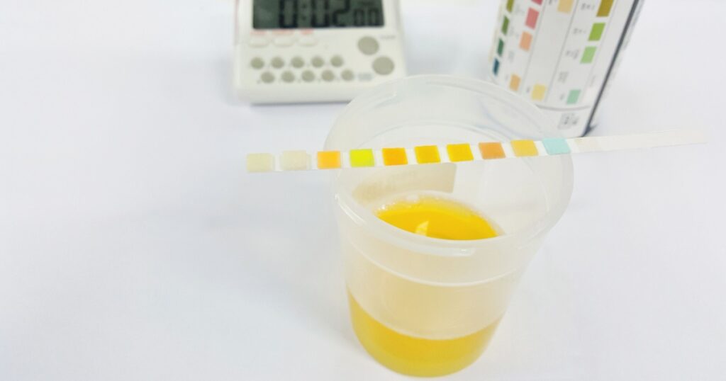Urine test strip or dipstick test used to determine pathological changes in a patient urine sample. The test read result in 60 to 120 seconds after immersed strip in urine specimen. Selective focus.
