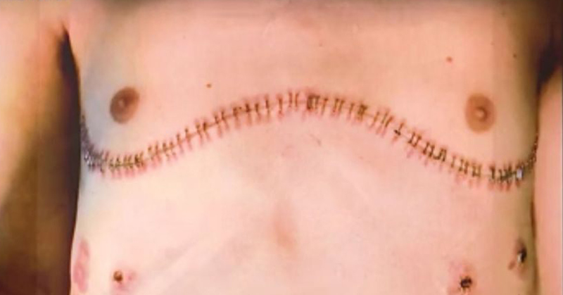 Chest showing stitches after major surgery