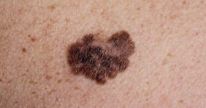 Know Your ABCDEs: 5 Signs of Melanoma to Look Out For brown mole looking melanoma on skin