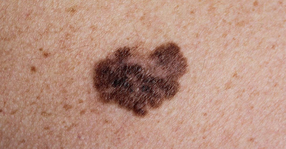 brown mole looking melanoma on skin