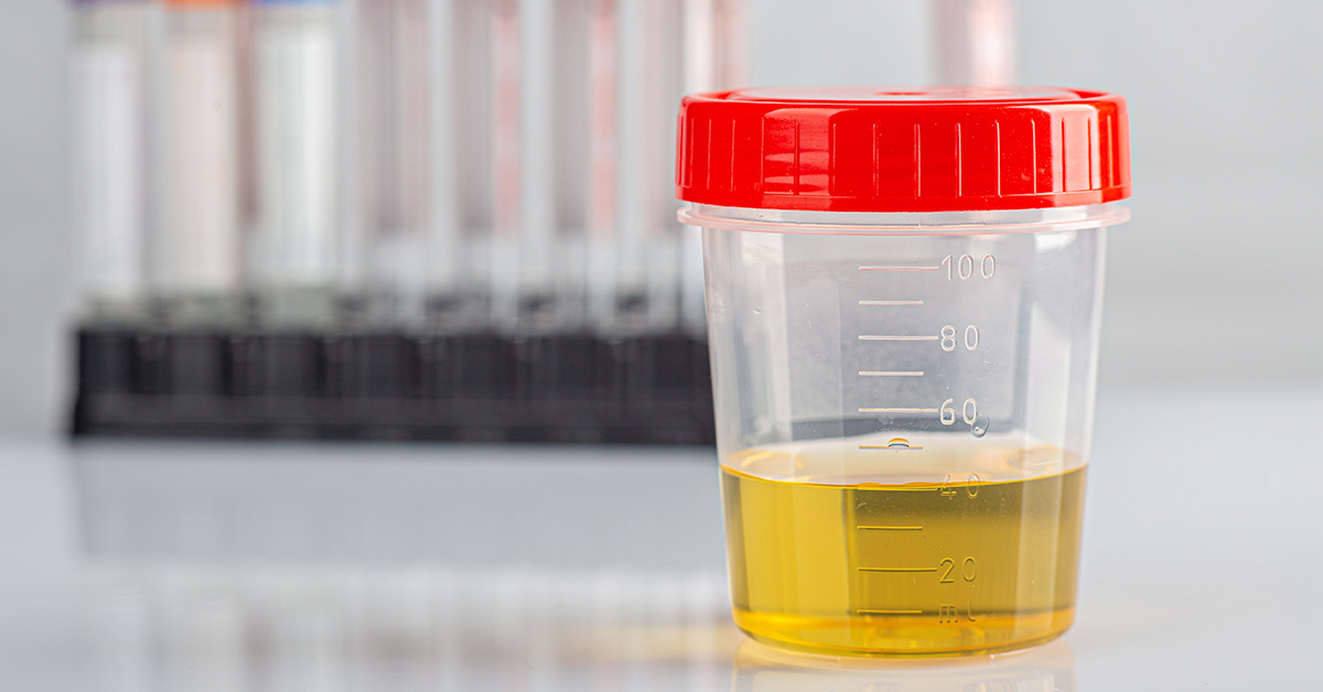 urine sample in clear collection cup with red lid