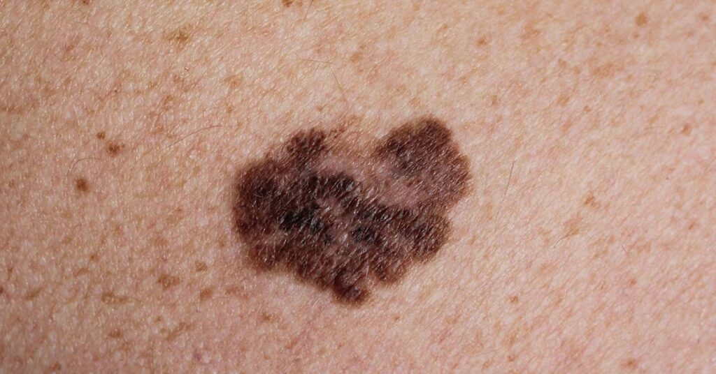 Video Time-Lapse Shows How Dark Patch of Skin Turns Into Melanoma Cancer - Featured image
