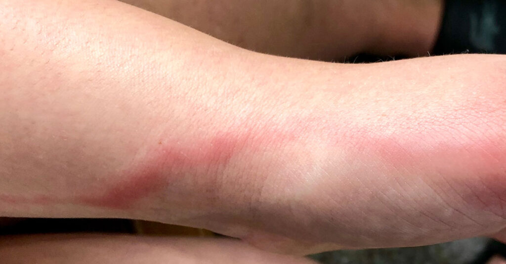 Parents Should Be On The Look Out for Red Tracking Lines That Can Appear On Their Children – Here’s Why - Featured image