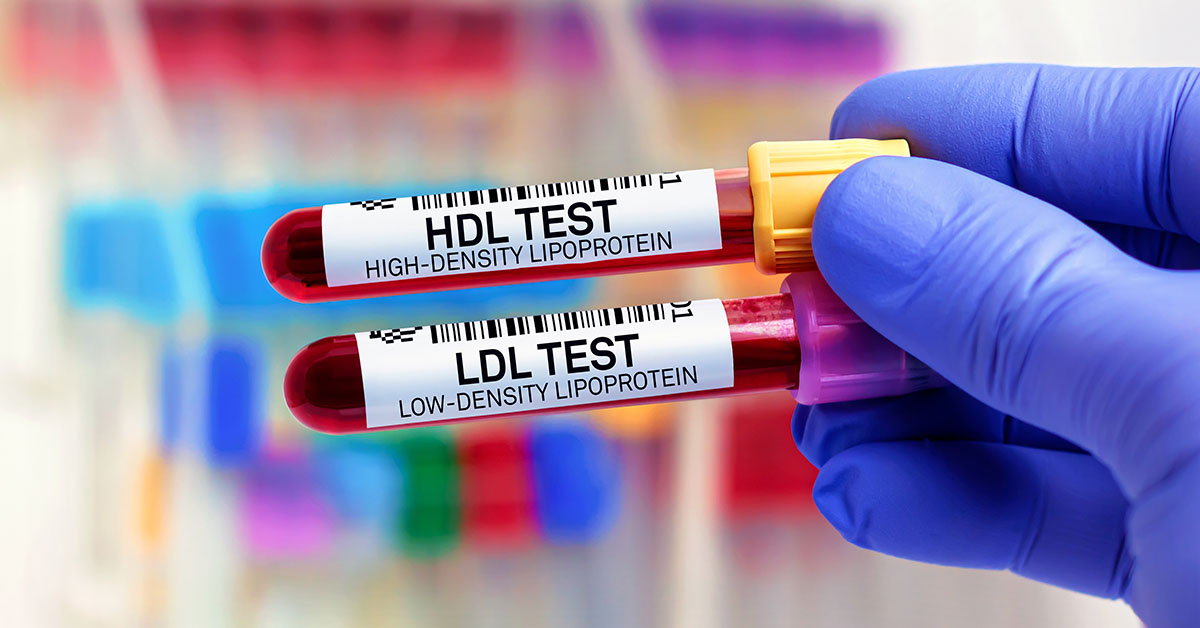 hand wearing latex glove holding two blood viles labelled LDL Test