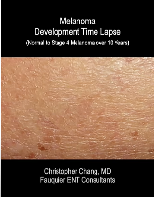 time lapse screen shot of progression of ,melanoma skin cancer 
