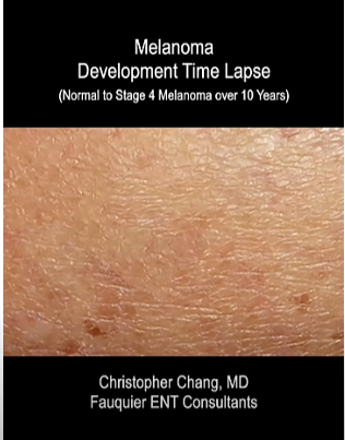 time lapse screen shot of progression of ,melanoma skin cancer