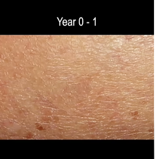 time lapse screen shot of progression of ,melanoma skin cancer