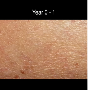 time lapse screen shot of progression of ,melanoma skin cancer 