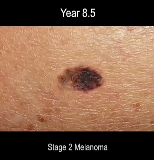 time lapse screen shot of progression of ,melanoma skin cancer