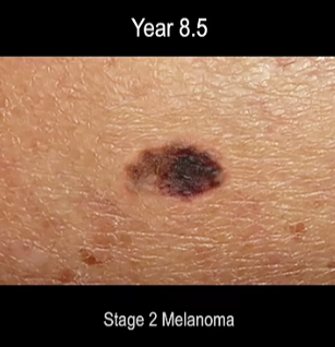 time lapse screen shot of progression of ,melanoma skin cancer 