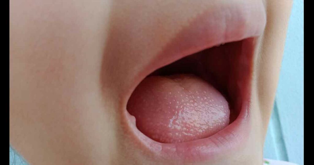 A child's mouth focus the tongue and papilla.