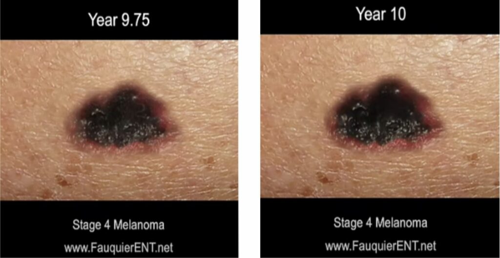 time lapse screen shot of progression of ,melanoma skin cancer 