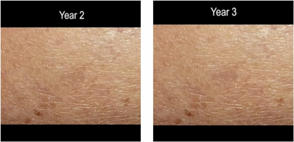 time lapse screen shot of progression of ,melanoma skin cancer 