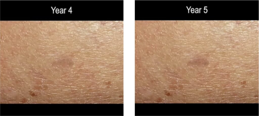 time lapse screen shot of progression of ,melanoma skin cancer