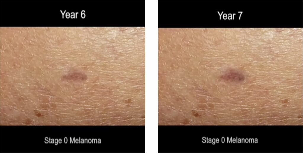 time lapse screen shot of progression of ,melanoma skin cancer 