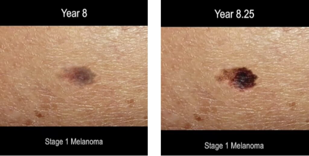 time lapse screen shot of progression of ,melanoma skin cancer 