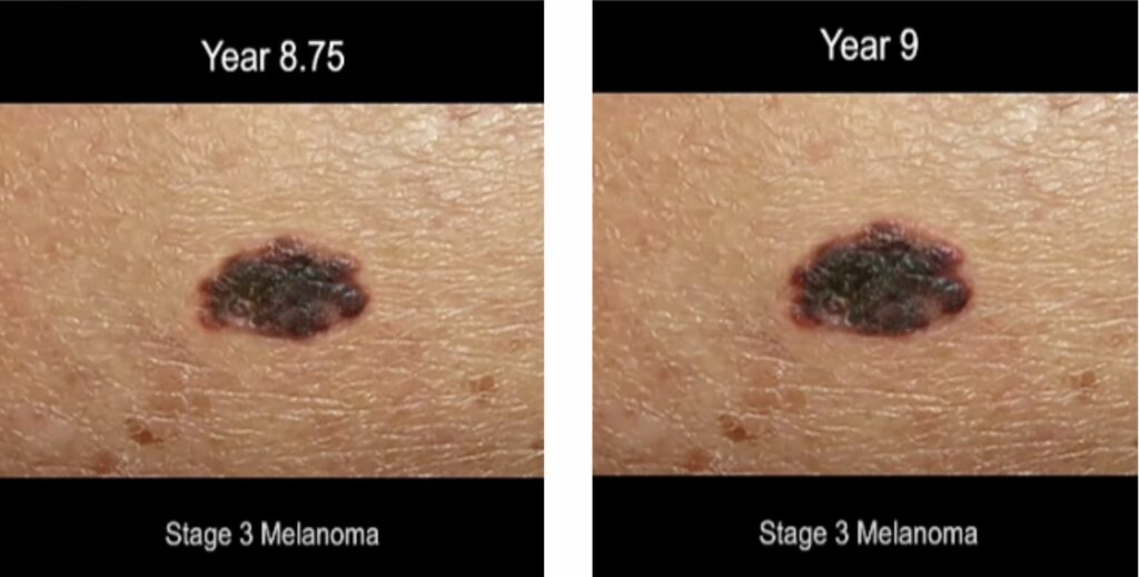 time lapse screen shot of progression of ,melanoma skin cancer