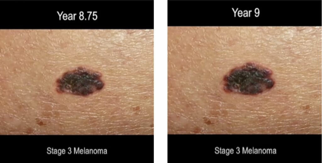 time lapse screen shot of progression of ,melanoma skin cancer 