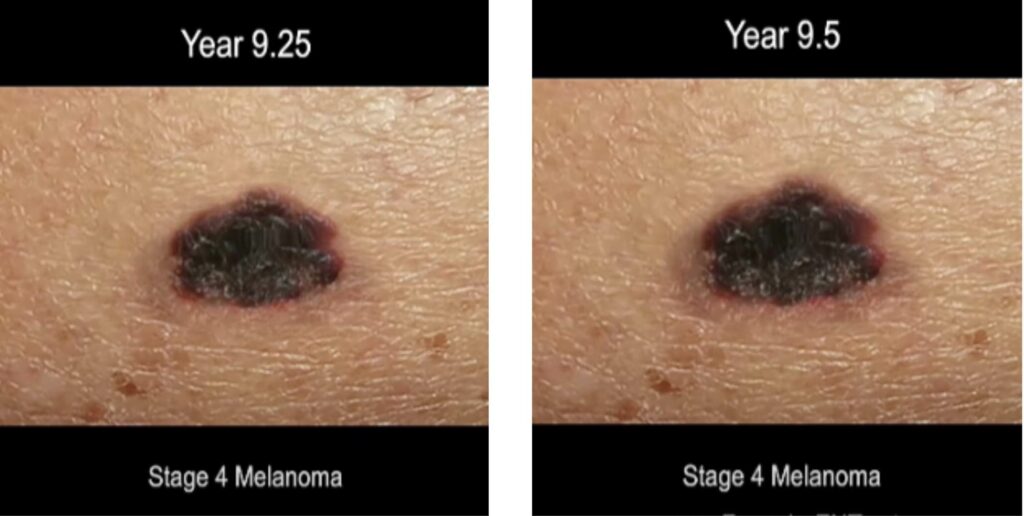 time lapse screen shot of progression of ,melanoma skin cancer