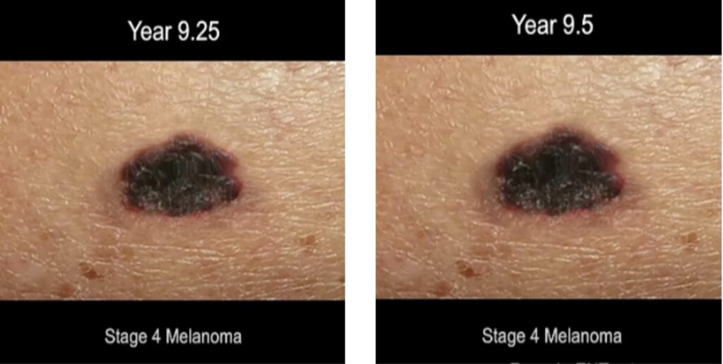 time lapse screen shot of progression of ,melanoma skin cancer 