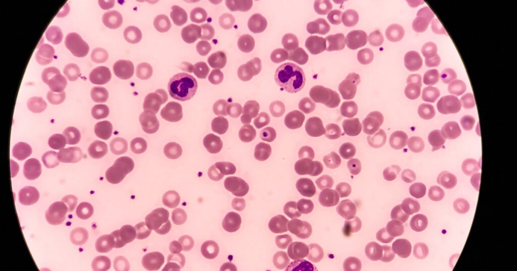Group of Neutrophil in peripheral blood smear of patient with Iron deficiency anemia.
