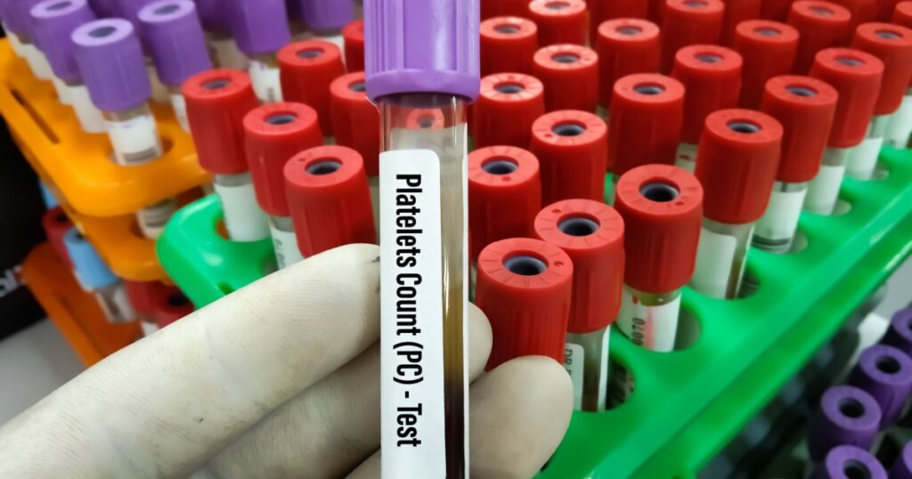 Doctor holding blood sample tube For Total count of WBC (TC), Differtial count of White blood cell,WBC (DC) and Plateletes count (TC) at medical laboratory.