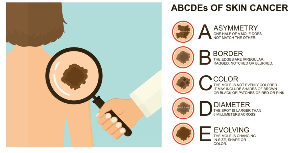 Diagnosis of skin cancer. Melanoma warning signs. Dermatological screening. UVB prevention of squamous cell treatment. Basal test. ABCDEs of skin cancer screening.