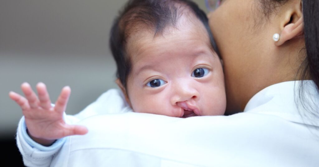 She is safe in her mothers arms. Portrait of a baby girl who has a cleft palate looking over the shoulder of her mother.