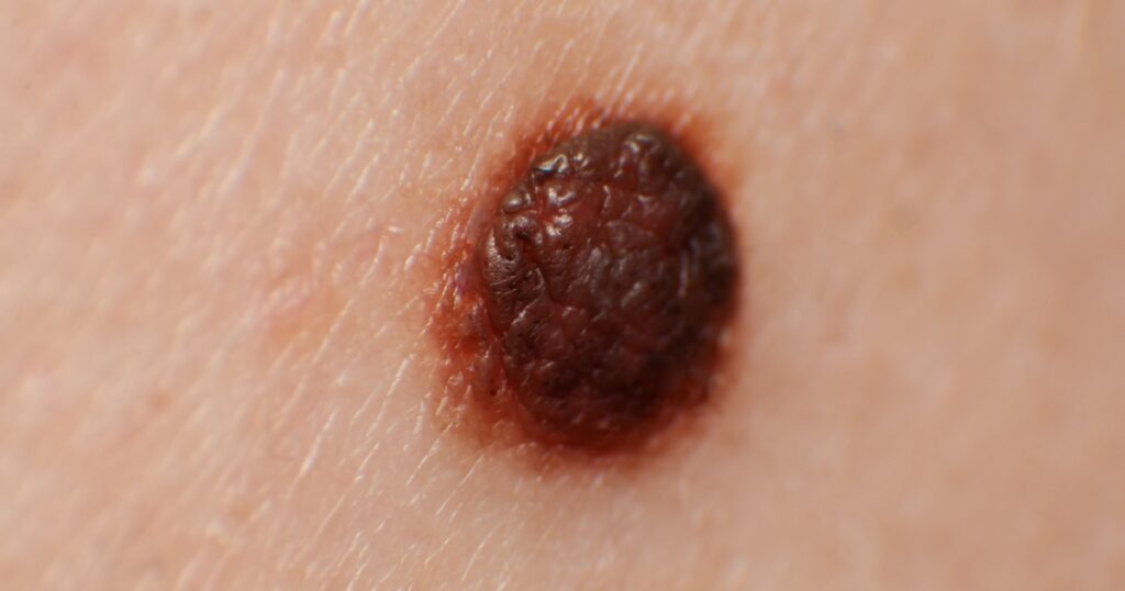 Precancerous mole - birthmark is potentially cancerous melanoma