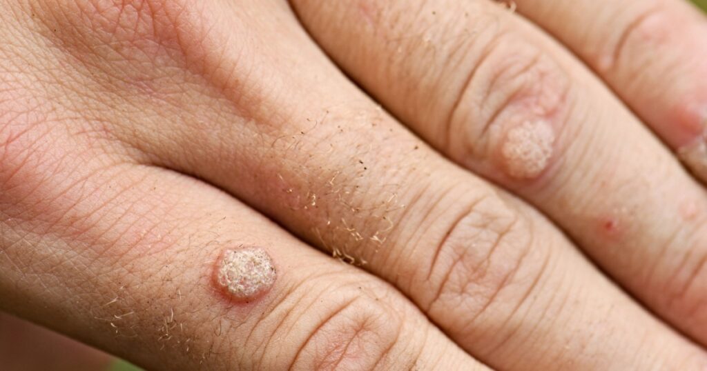 Home Remedies To Help Get Rid Of Those Stubborn Warts - Featured image