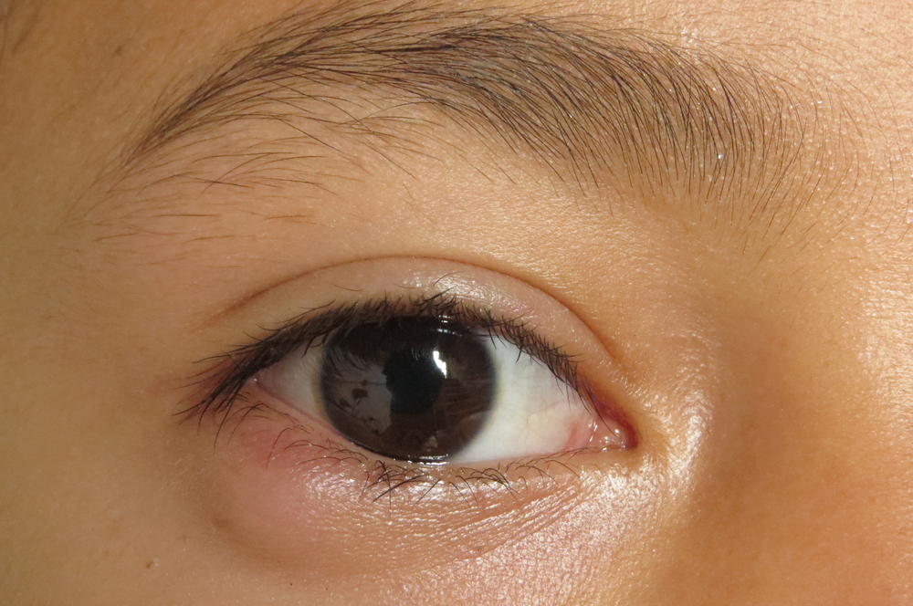 Outer view of nodule shaped style- chalazion on the lower eyelid of child. Papilledema ,selective focus.
