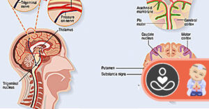 10 Natural and Effective Treatments For Headache and Migraine Relief supplements-migraine-relief