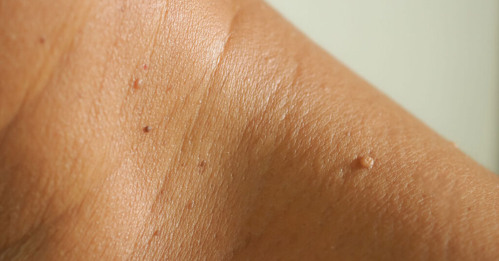 What Are Skin Tags? (Signs, Symptoms, and Remedies) - Featured image