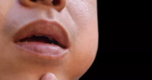 Having a Bad Taste in Your Mouth is a Common Sign of This Oral Condition close up of child's mouth displaying symptoms of mumps