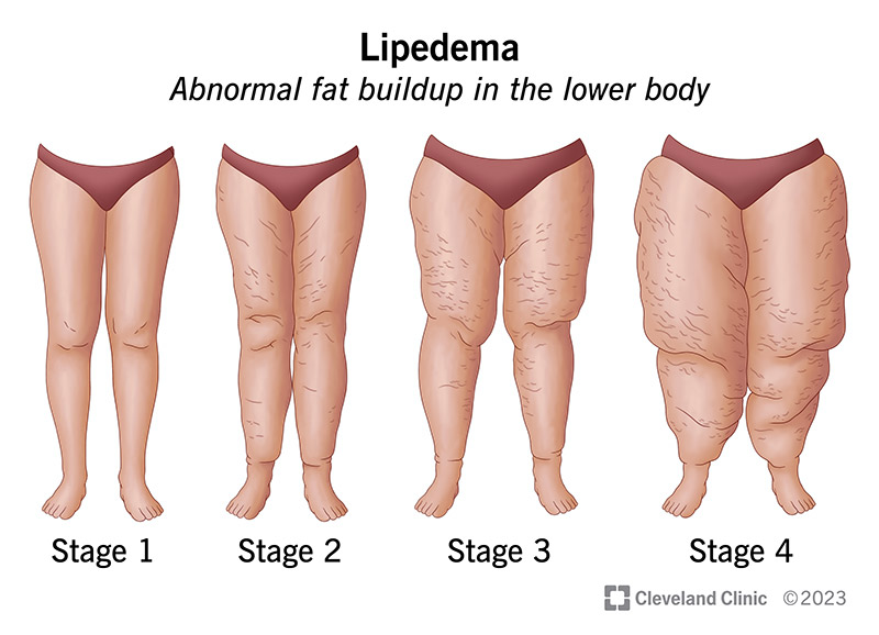 Lipedema causes abnormal fat buildup in your lower body, getting worse with time.
