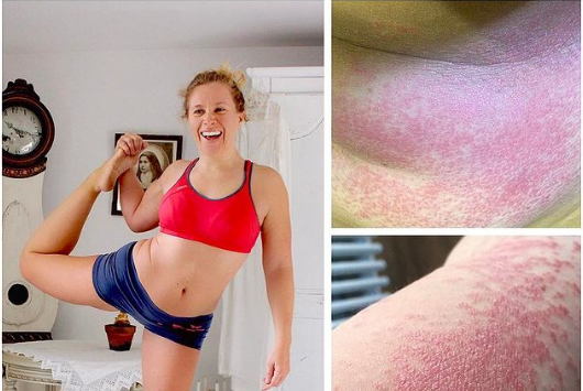 Instagram eczema picture