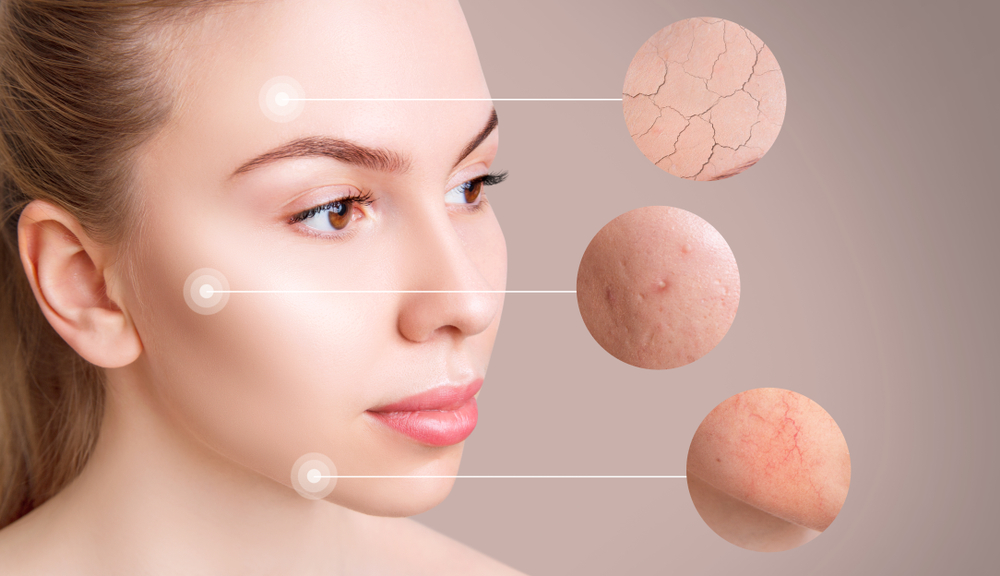 Magnifying circles demonstrate couperose and acne on face skin of young woman. Over beige background.