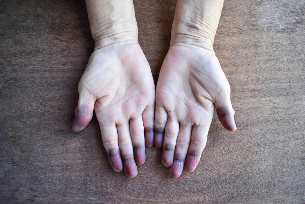 Cyanotic hands or peripheral cyanosis or blue hands at Southeast Asian, Chinese old woman with congenital heart disease.