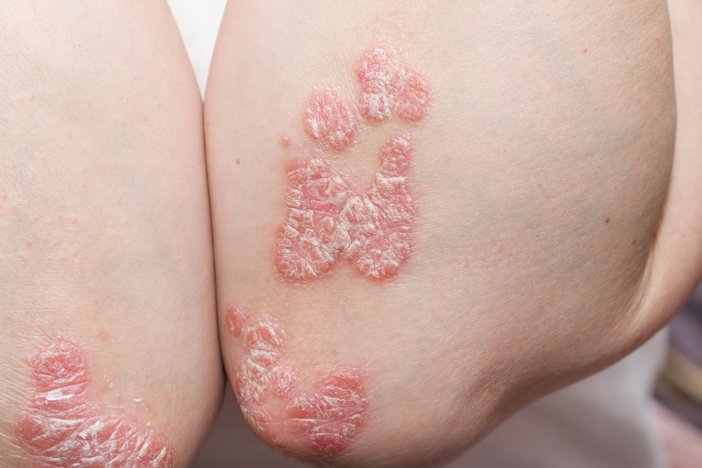 problem skin psoriasis on the body. exacerbation of psoriasis. stress and illness