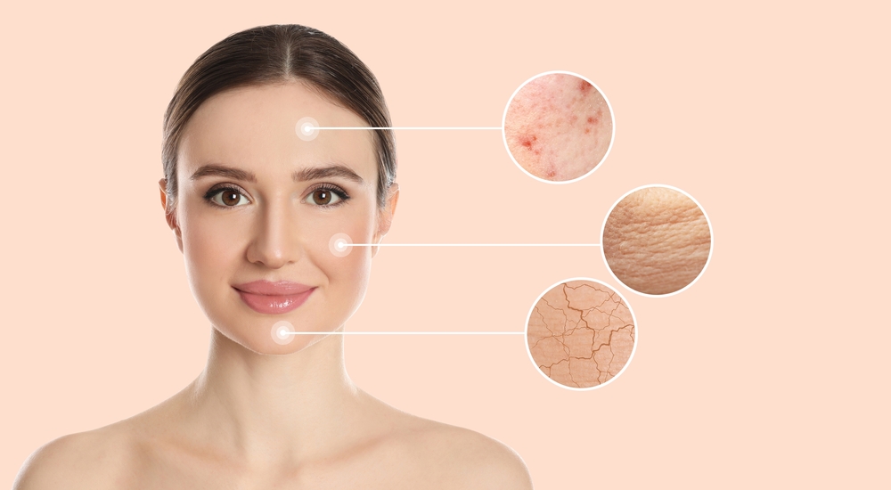 Young woman with skin problem on beige background