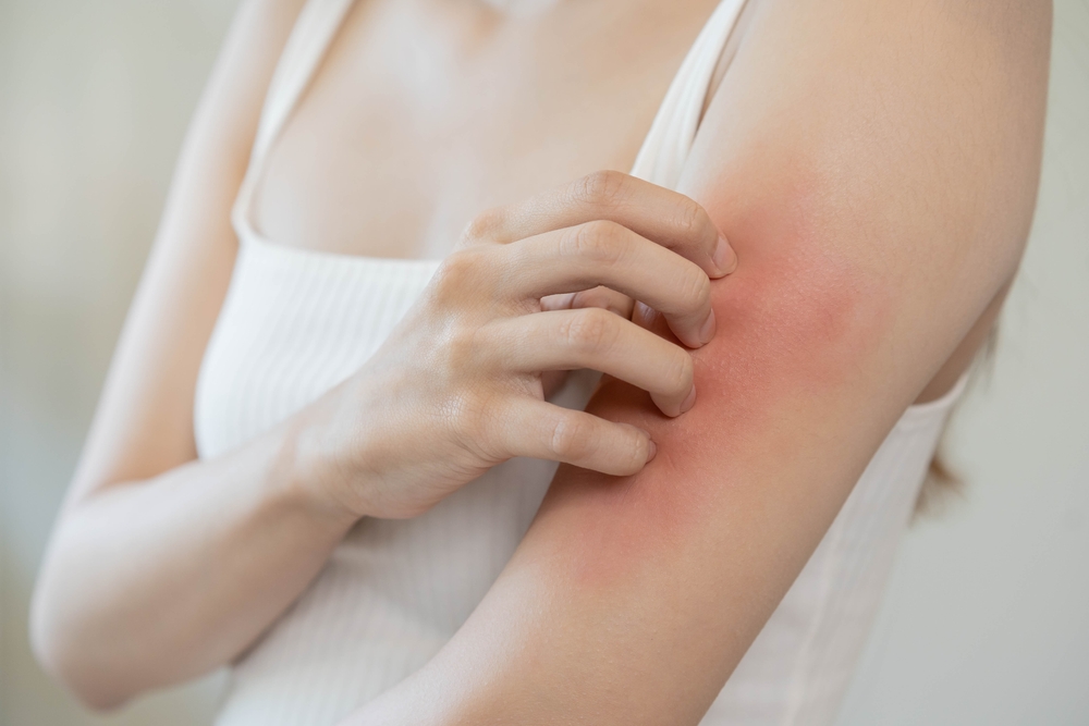 Dermatology, asian young woman, girl allergy, allergic reaction from atopic, insect bites on her arm, hand in scratching itchy, itch red spot or rash of skin. Healthcare, treatment of beauty.