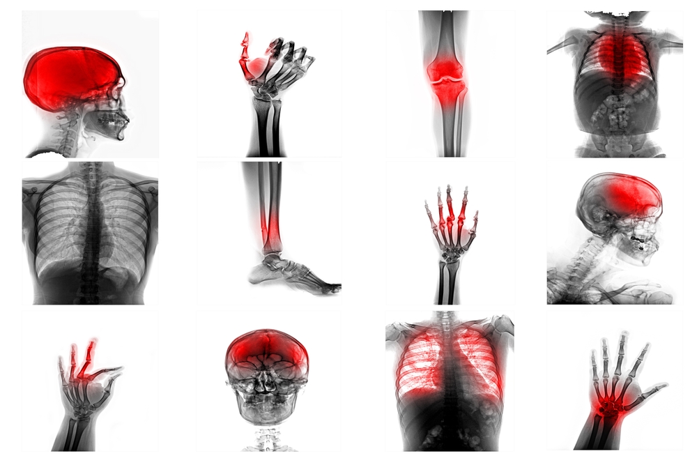 Collection X-ray and multiple facture and injury