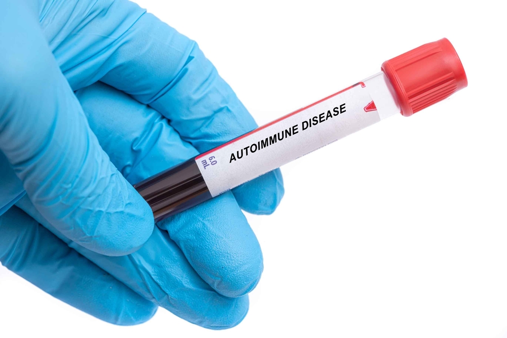 Autoimmune Disease. Autoimmune Disease disease blood test in doctor hand