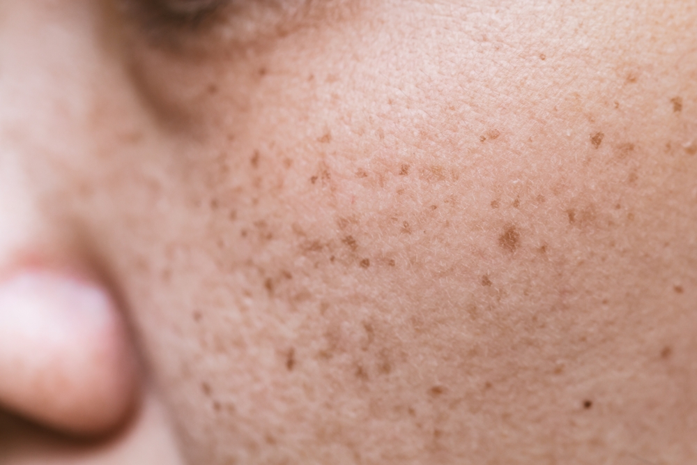 Freckles Over Asian Woman Face,Skin Problems