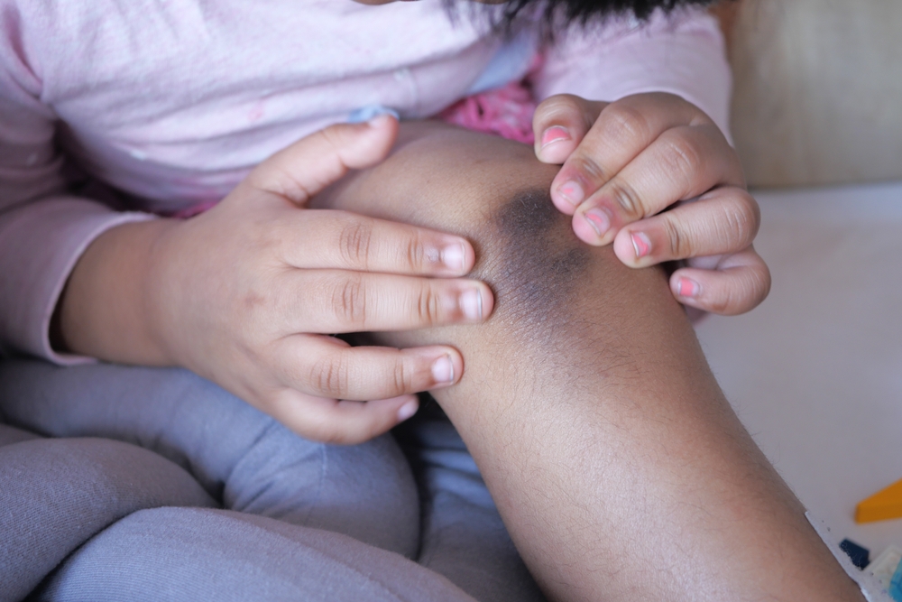 stain bruise wound on child knee.
