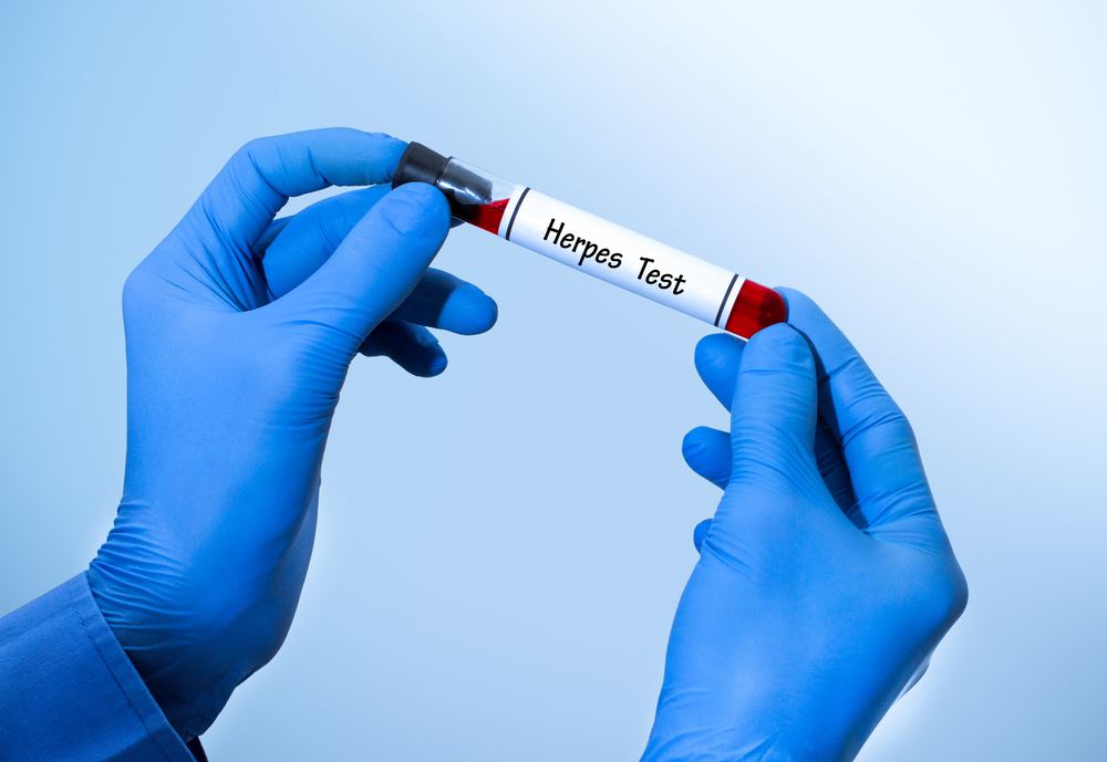Positive result of blood test for herpes. Test tube with a blood test in the doctor's hands. Medical concept.