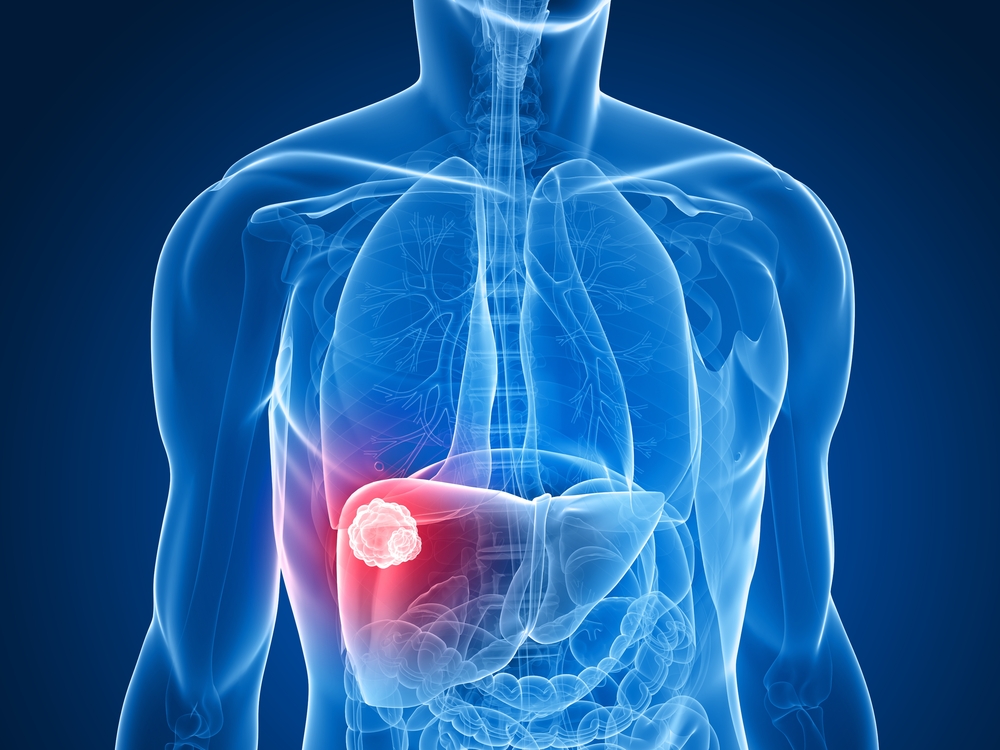 liver cancer