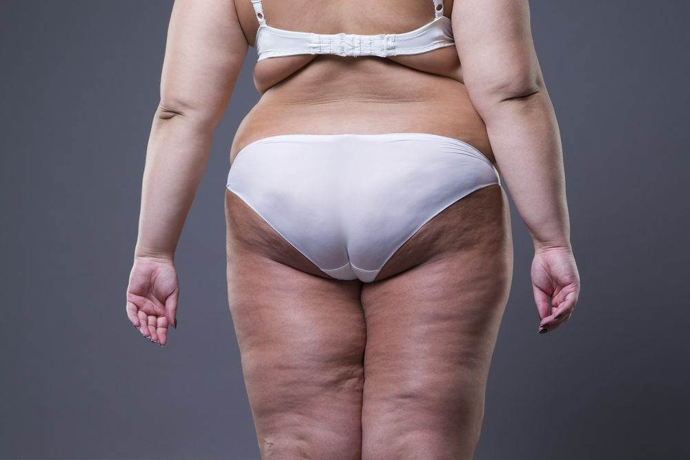 Overweight woman with fat legs and buttocks, obesity female body on gray background